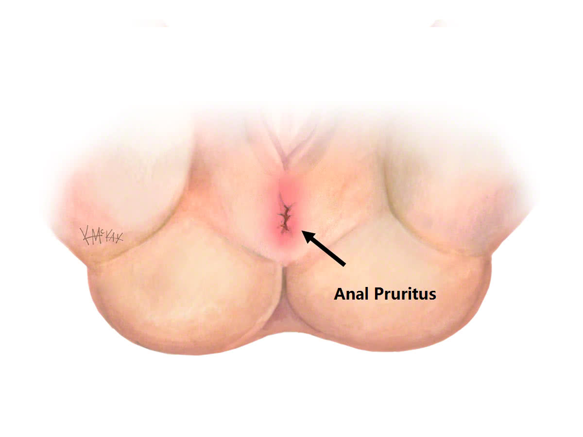 anal-pruritus_e