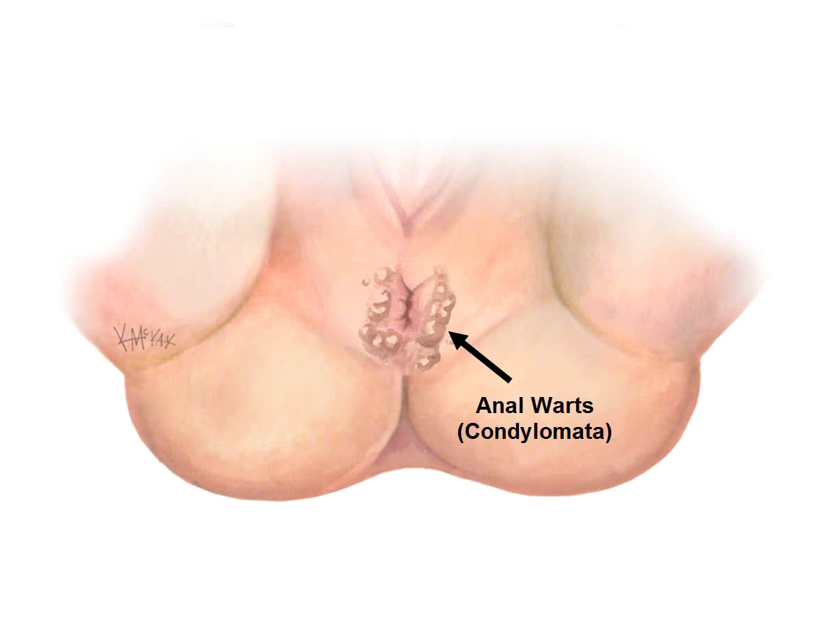 anal-warts_e