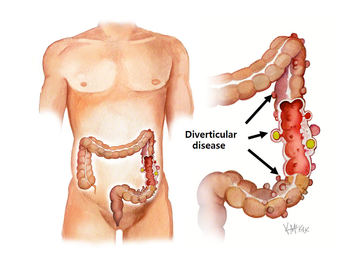 diverticular-disease_e