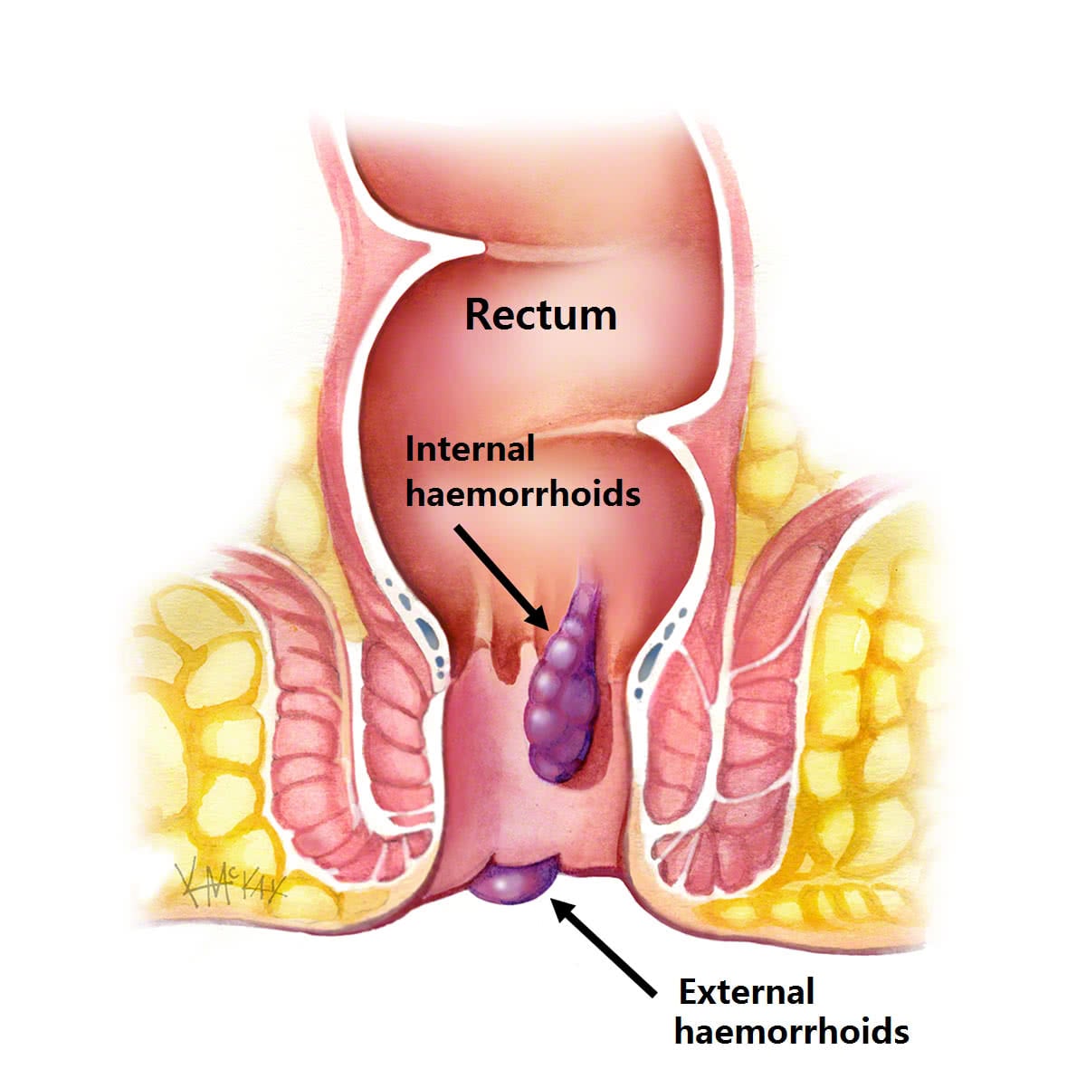 haemorrhoids_e