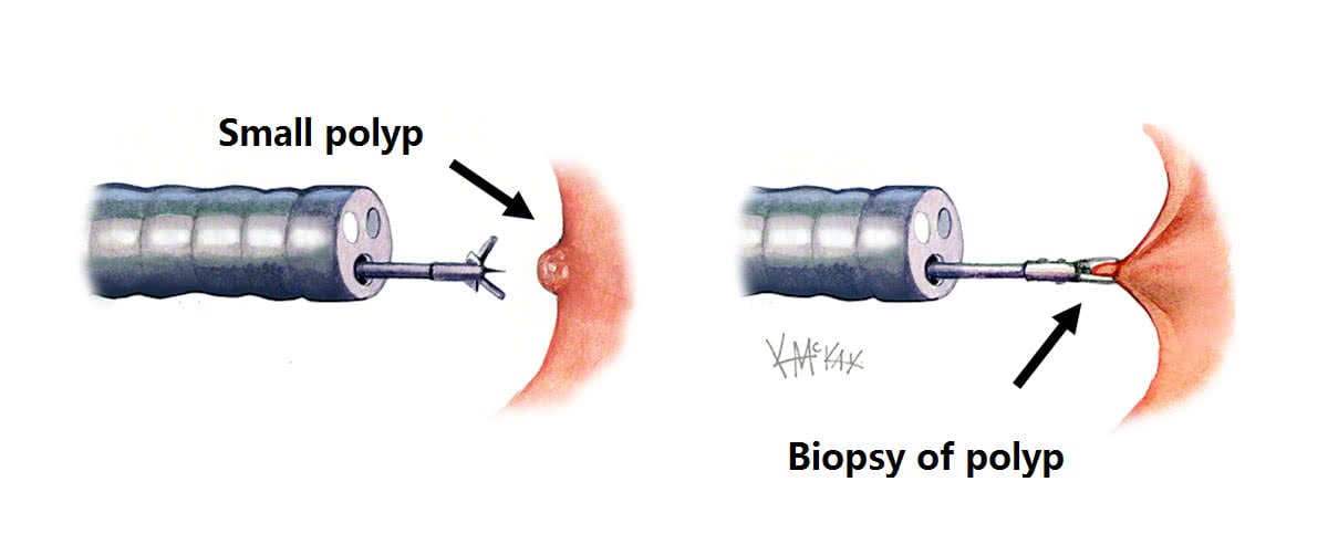 polypectomy_e