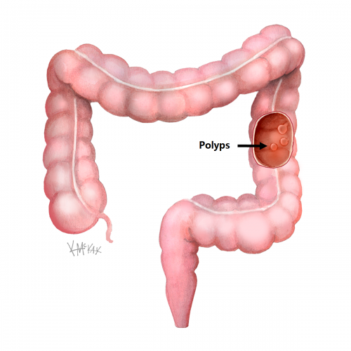 Polyps – Specialist Surgeons Sydney
