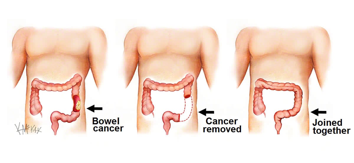 bowel-cancer-surgery
