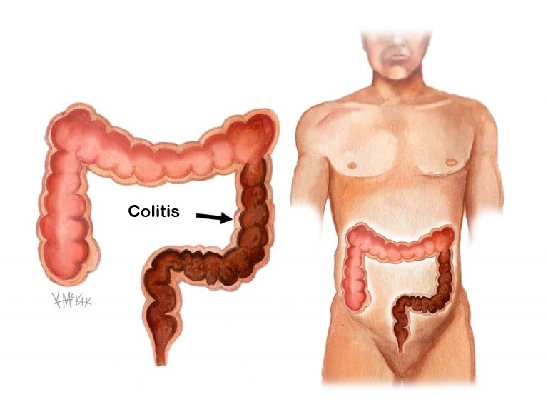 colitis