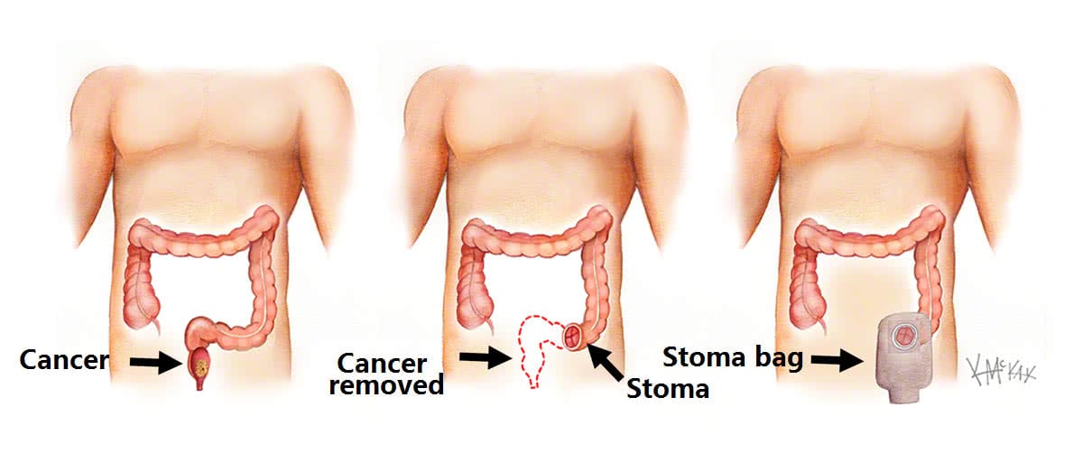 permanent-stoma