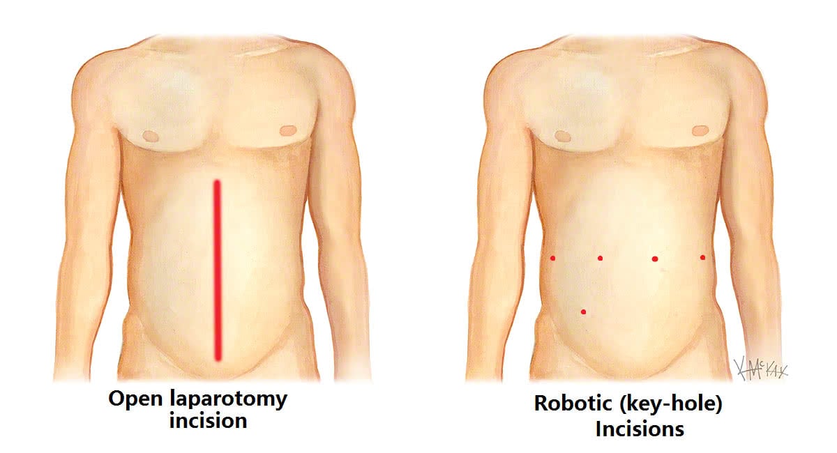 robotic-incisions
