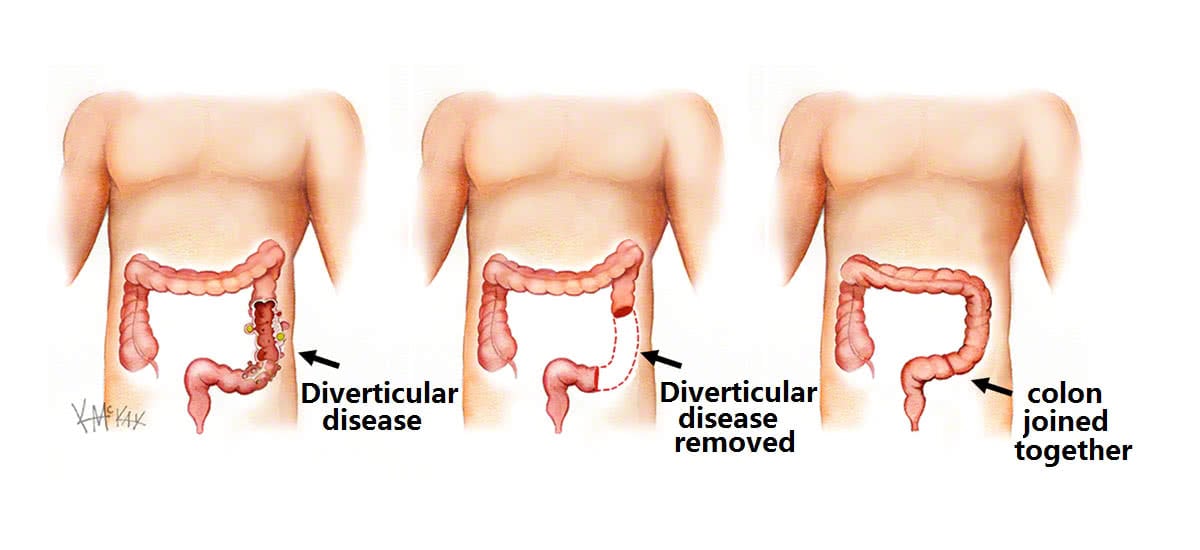 surgery-for-diverticular-disease