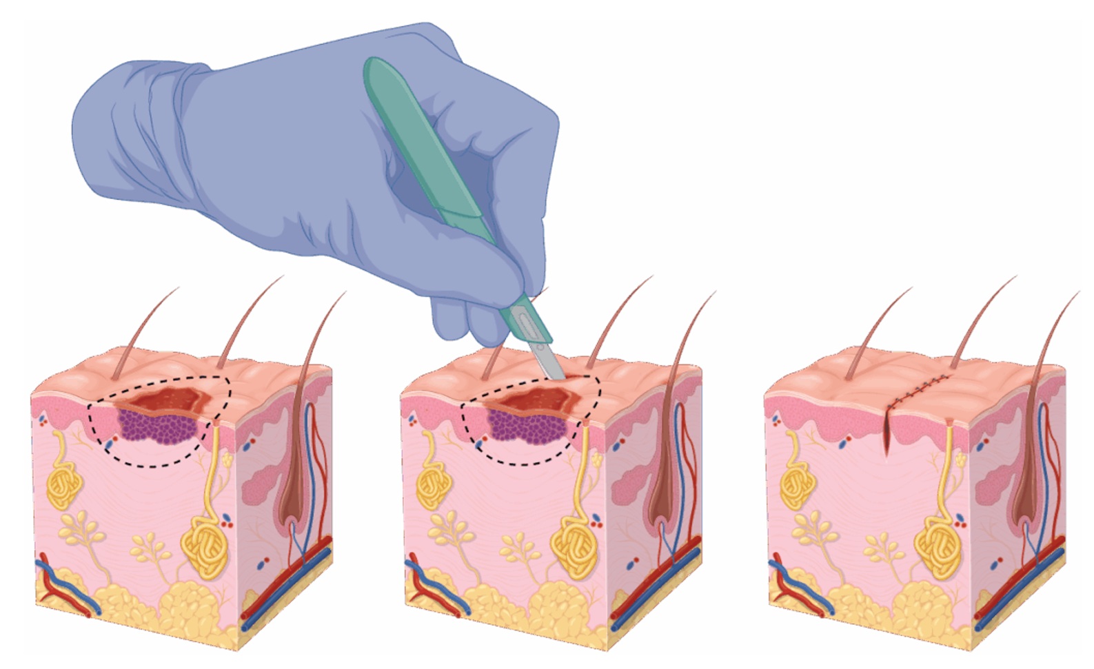 excision-of-skin-lesion-lumps-and-bumps-under-local-anaesthetic