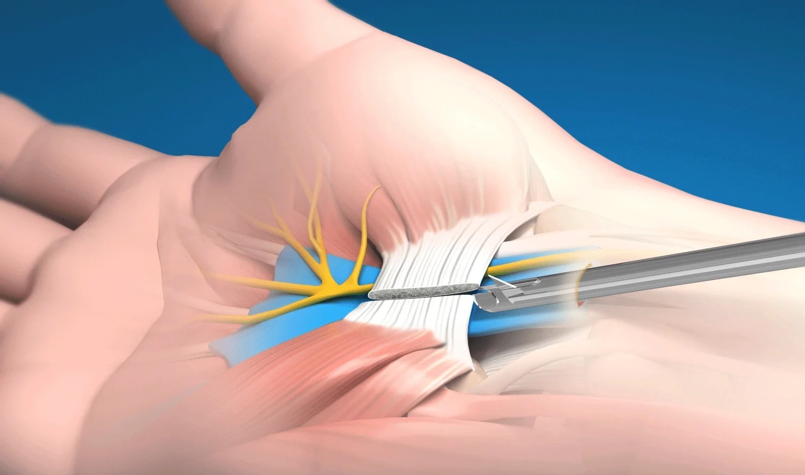 minimal invasive open carpal tunnel release