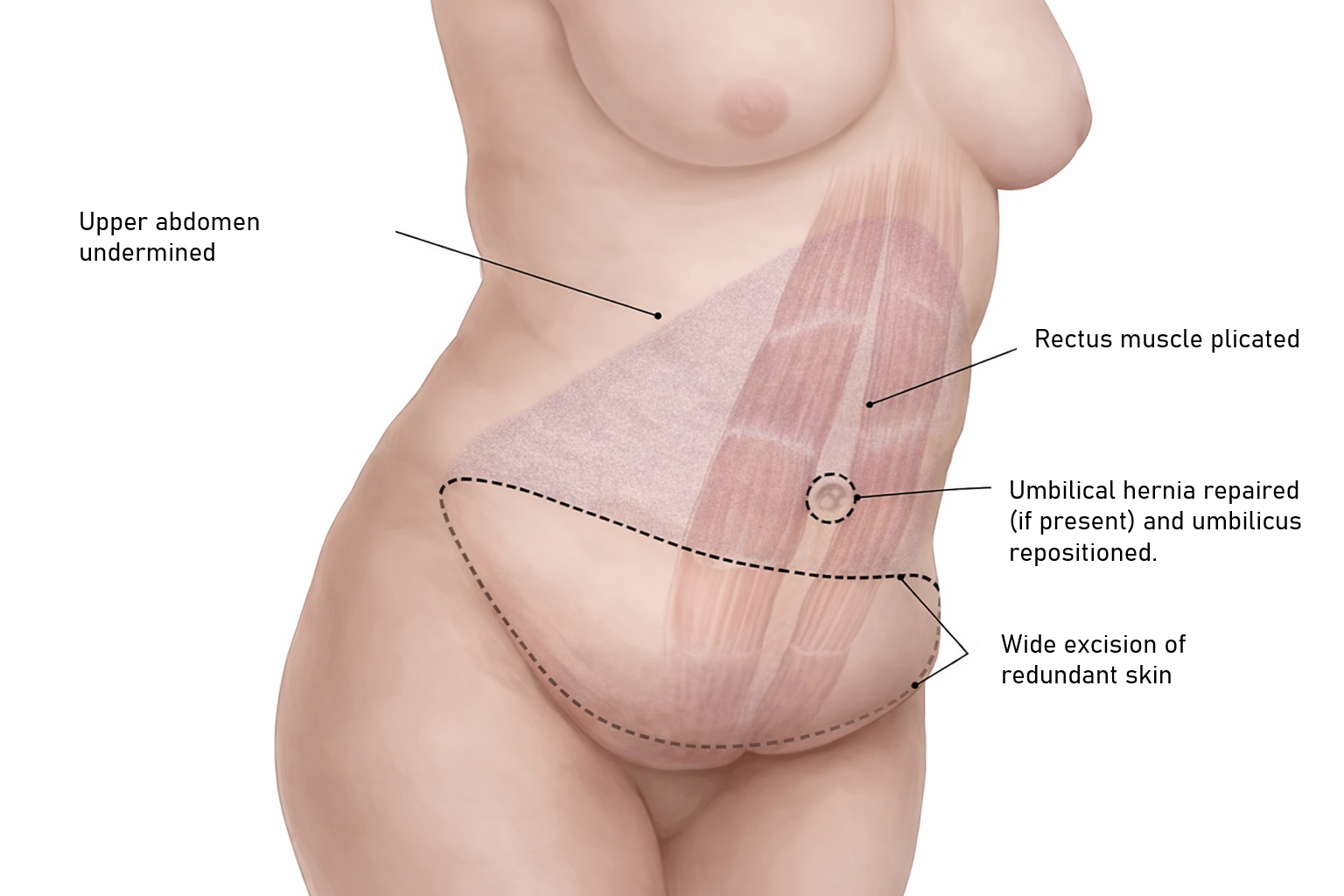 abdominoplasty