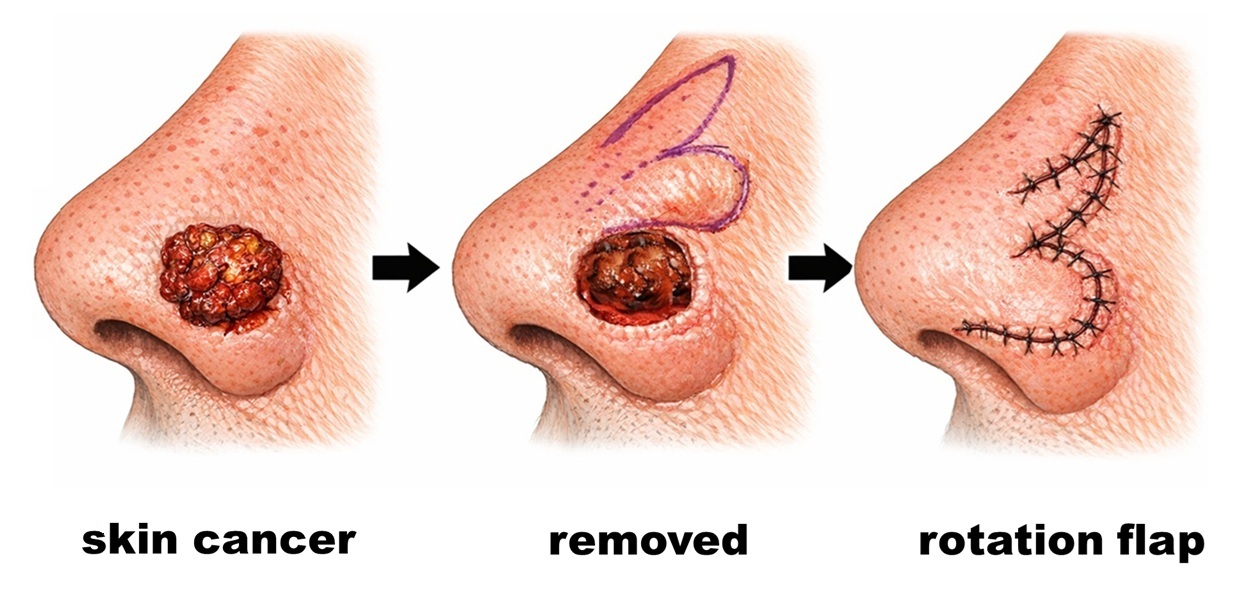 ROTATION FLAP RECONSTRUCTION