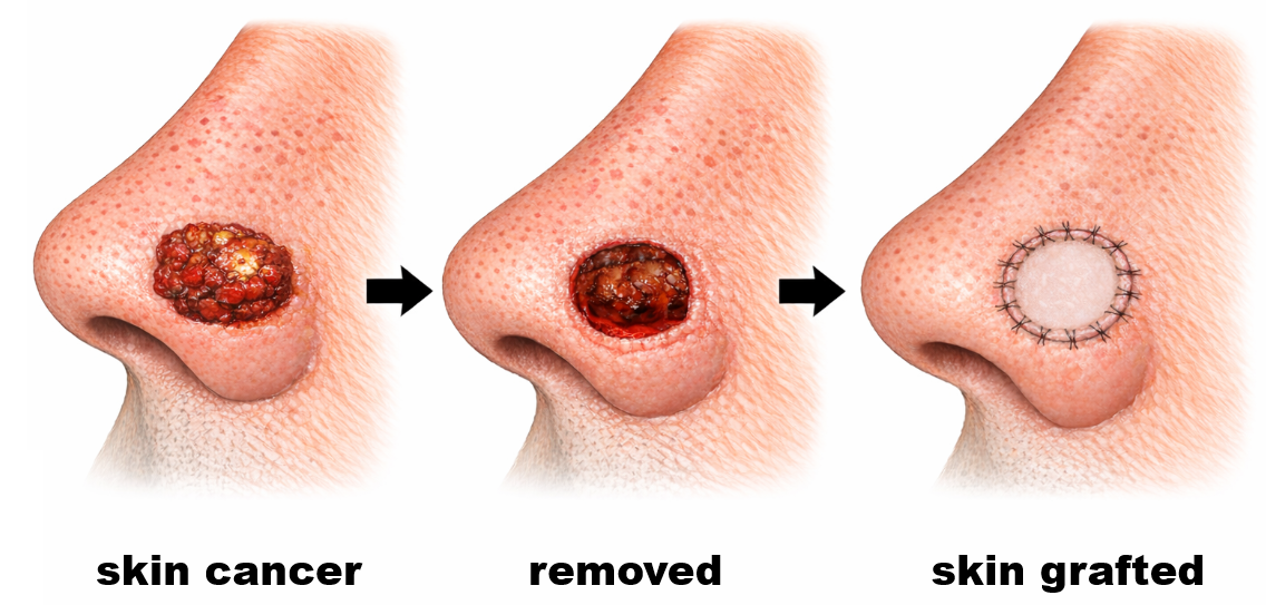 SKIN GRAFT
